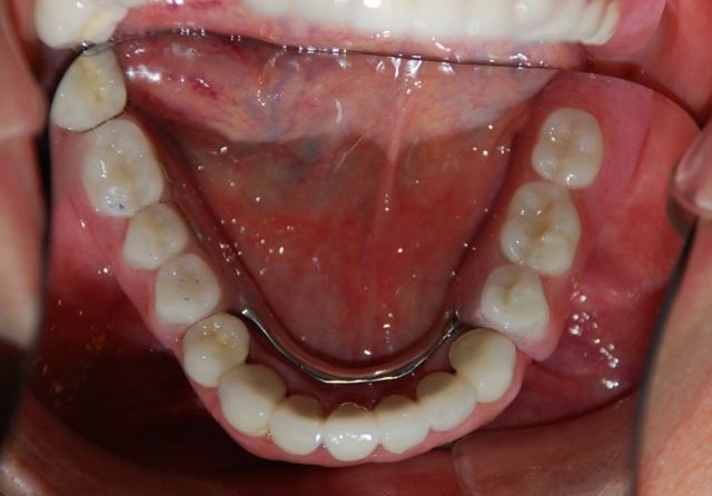 Vampire Teeth Dentures Fillmore IL 62032